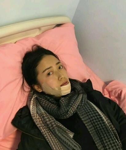 下巴后缩垫下巴案例,垫了下巴膨体皮肤松弛严重