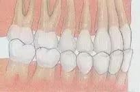 小孩牙齿反颌治疗方案,儿童牙齿反颌矫正要多少钱