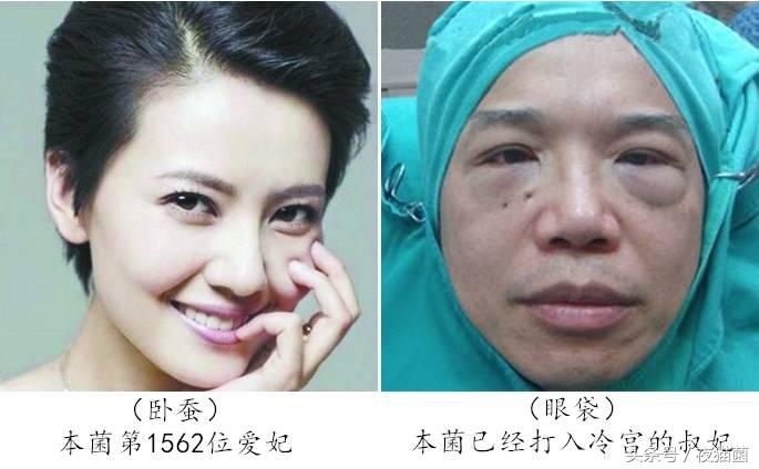 长期熬夜眼袋很严重怎么去除,熬夜怎样去除黑眼圈眼袋