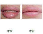 改善不完美的唇型,怎样的唇型是完美唇型