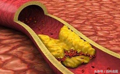 动脉硬化的食疗方法有哪些,动脉硬化可以吃什么调理