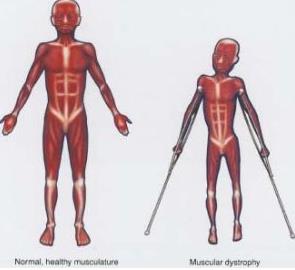 进行性肌营养不良症筛查,进行性肌营养不良问诊