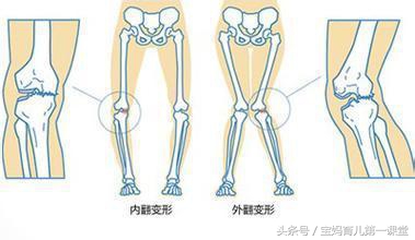 宝宝肋骨外翻医生说佝偻病,婴儿佝偻病腿弯