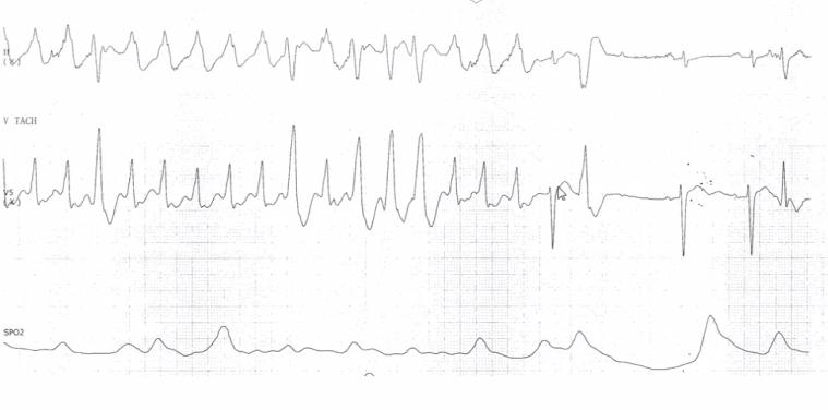 冠状动脉粥样硬化性心脏病知识点,冠状动脉粥样硬化性心脏病怎样治