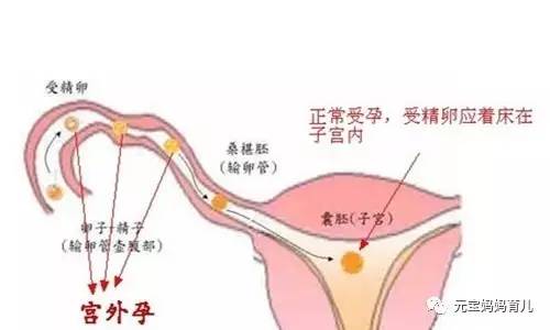 女的宫外孕跟男人有关系吗,6类女性易患宫外孕