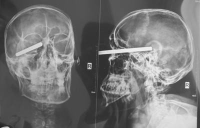 精神病、神经病、神经症是什么？让心理专家告诉你！