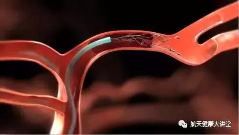 脑卒中的防治健康讲座,急性脑卒中科普知识