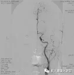 脑卒中的防治健康讲座,急性脑卒中科普知识