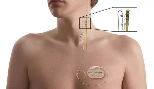 辅助迷走神经刺激术（VNS）治疗难治性抑郁