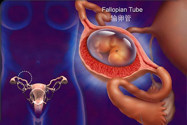 宫外孕大出血需要怎么处理,宫外孕为什么会引起大出血