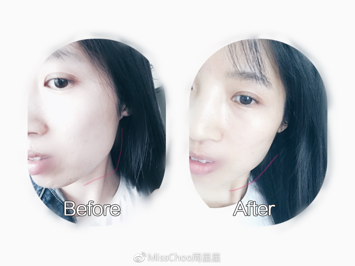 这个高科技，真的能还你十年胶原蛋白？