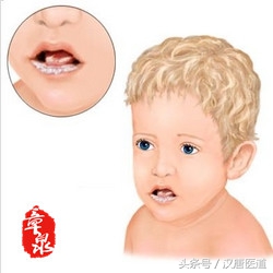 宝宝鹅口疮症状,宝宝鹅口疮的症状与治疗