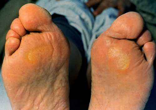 认识指甲死皮,认识足字旁