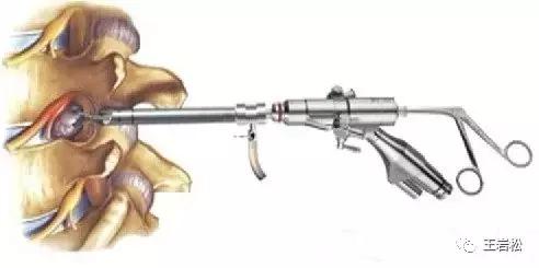 腰椎微创技术的临床应用,目前最热门腰椎微创技术椎间孔镜