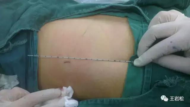 腰椎微创技术的临床应用,目前最热门腰椎微创技术椎间孔镜