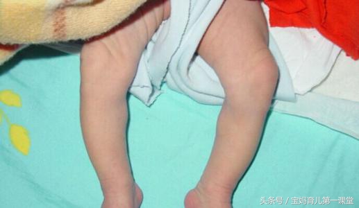 宝宝肋骨外翻医生说佝偻病,婴儿佝偻病腿弯