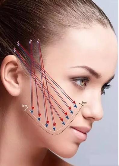 最火的徒手面部提拉,3d面部柔线提拉术