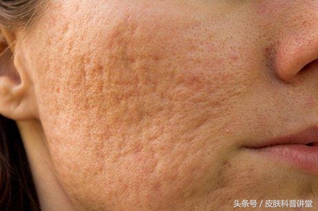 果酸焕肤精华液与果酸的区别,果酸换肤适合角质层薄的人吗