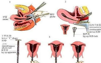 取环和清宫哪个受罪,女性取环有多痛苦