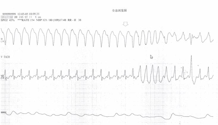 冠状动脉粥样硬化性心脏病知识点,冠状动脉粥样硬化性心脏病怎样治