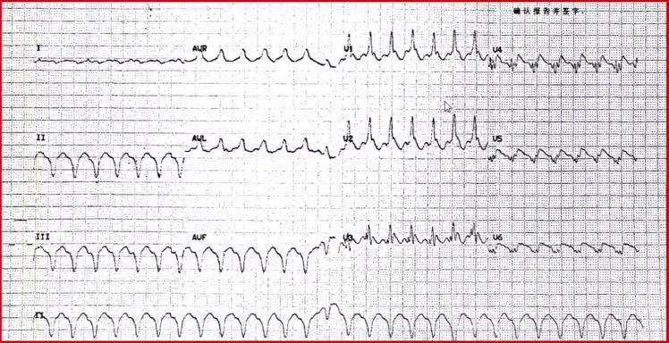 冠状动脉粥样硬化性心脏病知识点,冠状动脉粥样硬化性心脏病怎样治
