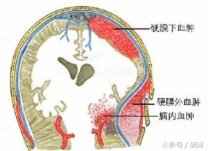 头部撞击会损坏大脑么,头颅撞击会有什么状况