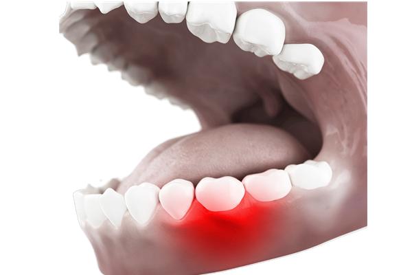 牙齿有点开裂牙龈发炎要拔牙吗,牙齿根尖发炎必须拔牙吗