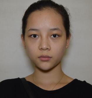 韩式三点定位恢复图片,韩式三点双眼皮恢复一个月图片