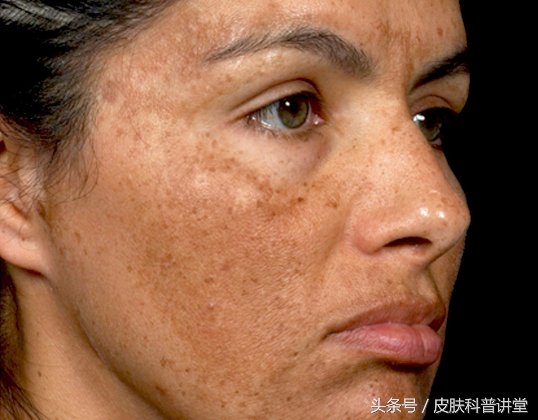 果酸焕肤精华液与果酸的区别,果酸换肤适合角质层薄的人吗