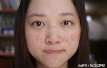 如何祛除痘印男性,如何祛除痘印男生