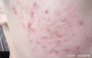 痘坑痘疤怎么遮瑕,修复痘坑痘疤神器