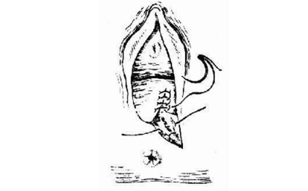 关于会阴侧切的真相，医生不一定会全告诉你！