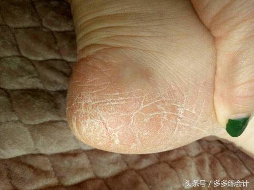 脚干裂开刀有什么好办法 (请问专家脚干裂怎么治)