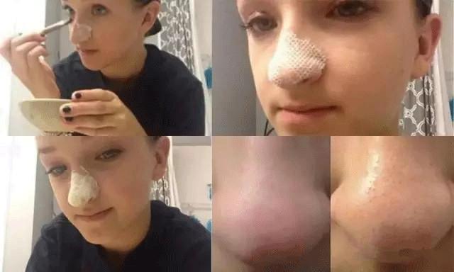 清洁黑头力度大告别草莓鼻,去黑头教程不伤毛孔