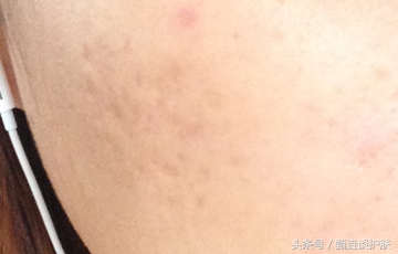 痘坑痘疤怎么遮瑕,修复痘坑痘疤神器