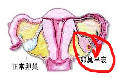 怎么自测是不是卵巢早衰,怎样自测自己卵巢是否有肿块