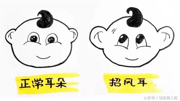 新生婴儿招风耳怎么矫正,招风耳宝宝命不好