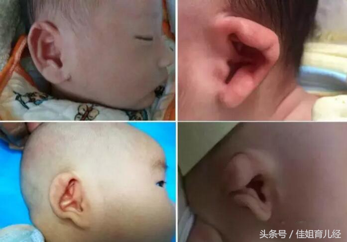 新生婴儿招风耳怎么矫正,招风耳宝宝命不好