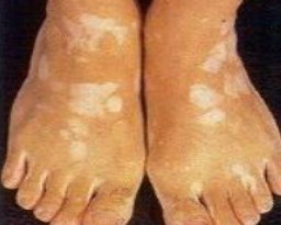 白癜风治疗要多久？还有哪些要注意？