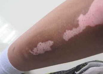 白癜风治疗要多久？还有哪些要注意？