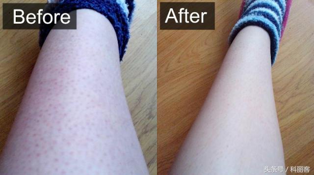 改善毛孔粗大最简单有效的方法,如何有效改善毛孔粗大的方法