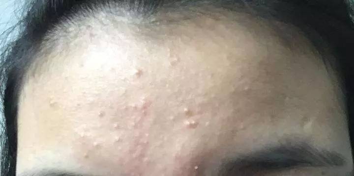 脸上长一堆密密麻麻的闭口怎么办,脸上长了特别多的闭口该怎么办