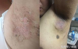 狐臭手术后遗症有哪些症状表现,切除腋下狐臭手术有什么后遗症