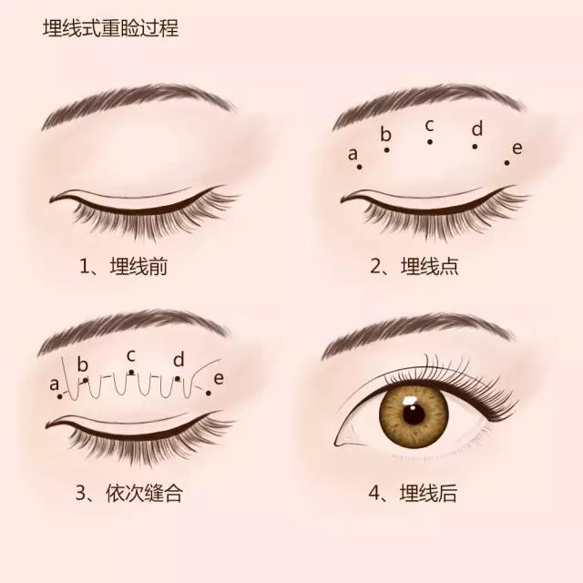 给自己点耐心：双眼皮术后一定要有一段恢复期！