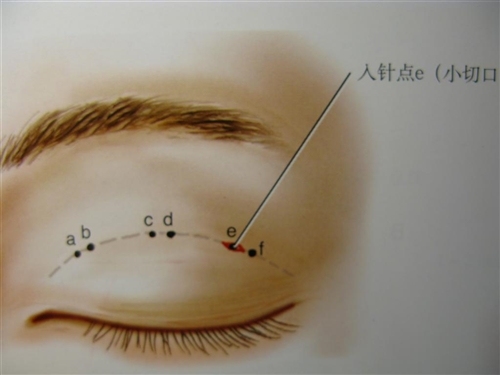 给自己点耐心：双眼皮术后一定要有一段恢复期！