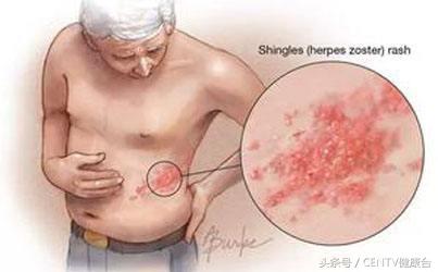 腰上长了一些水泡是不是蛇缠腰,腰上长了一圈小疙瘩是缠腰蛇么