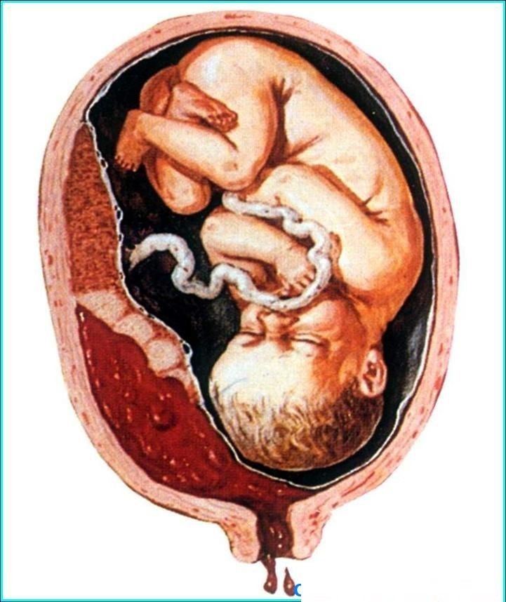 孕晚期出血不在意？别领孩子走向鬼门关！