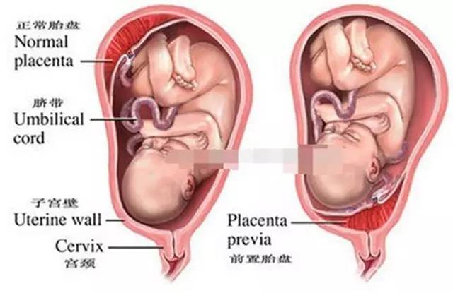 孕晚期出血不在意？别领孩子走向鬼门关！