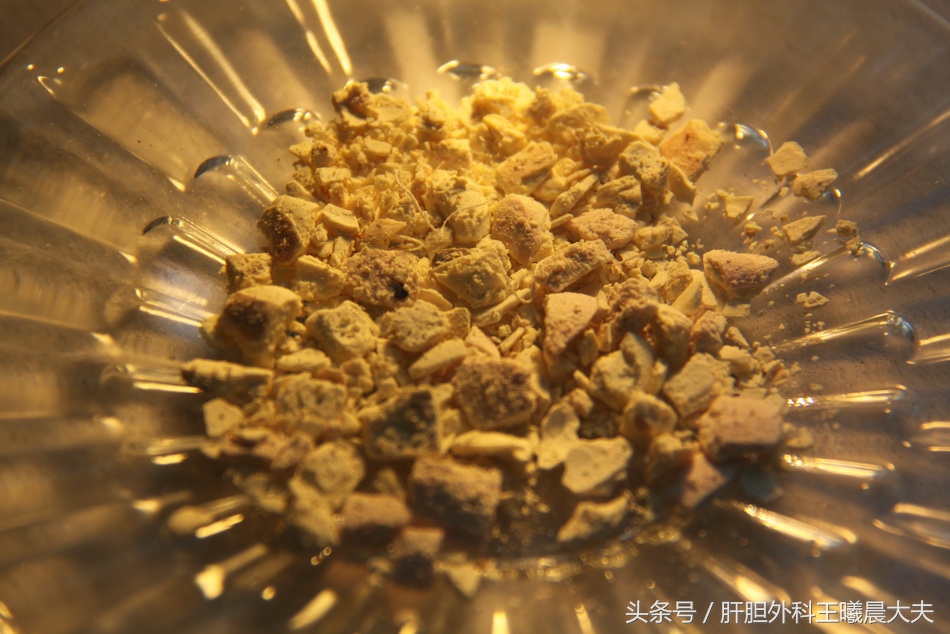 胆结石的危险因素不包括年龄性别,胆结石风险标识