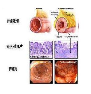 克罗恩病的简介,克罗恩病到底是什么